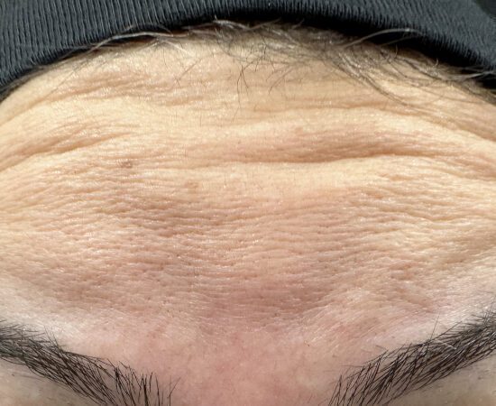 antiwrinkle before