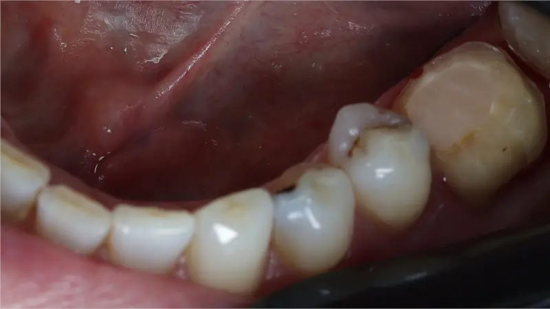 dentures before