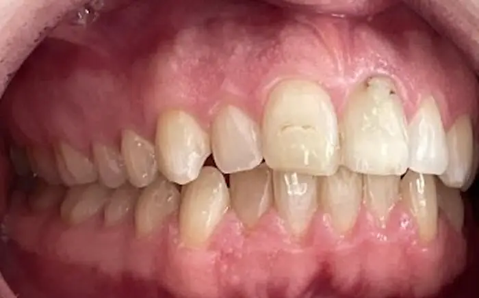 dentures before