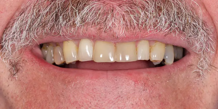 dentures after