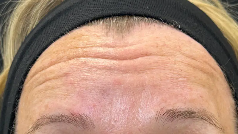 Anti-Wrinkle Before