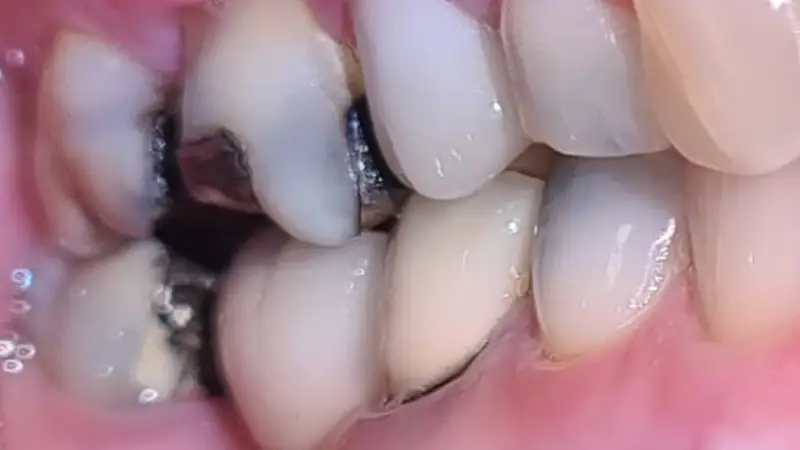 Implant After