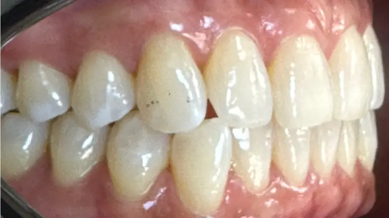 Whitening After