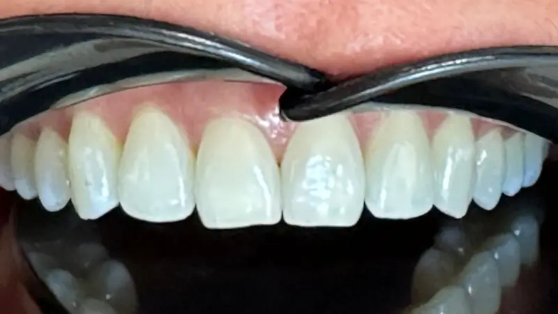 Whitening After