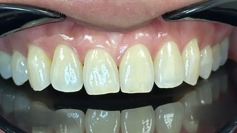 Whitening before