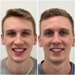 Before and After - CF