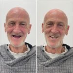 Before and After - TH
