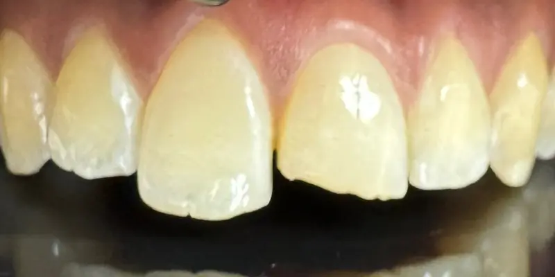 Composite Restorations Before