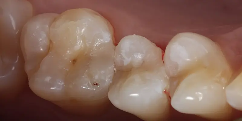Composite Restorations After