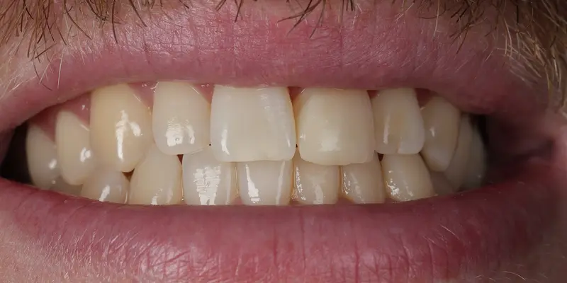 Composite Restorations After