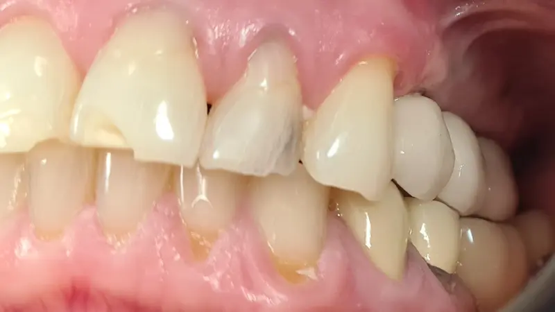 Implant After