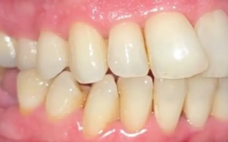 invisalign before