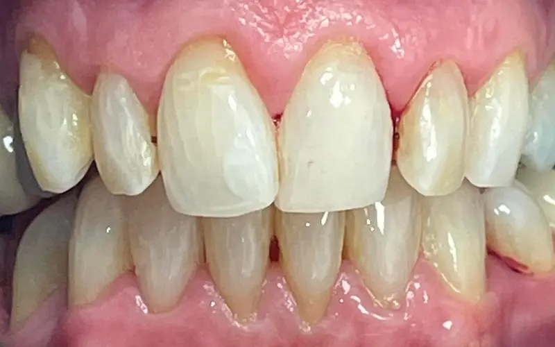 invisalign before