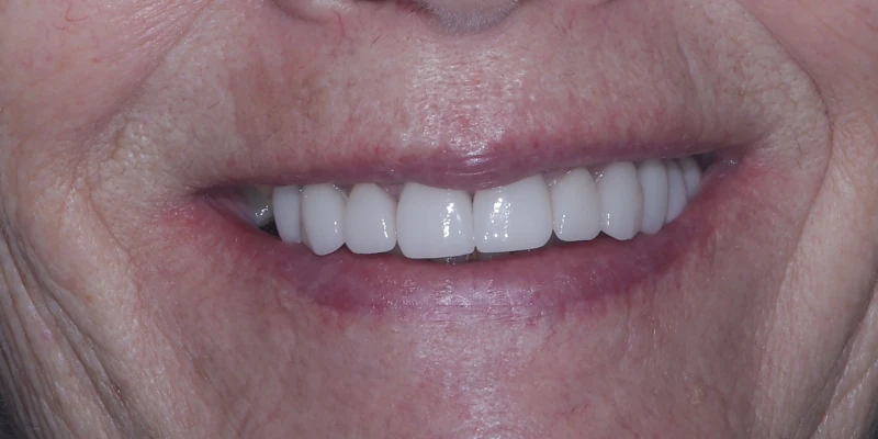 smile makeover after