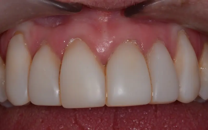 veneer before