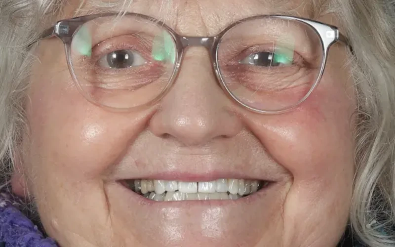 Whitening After