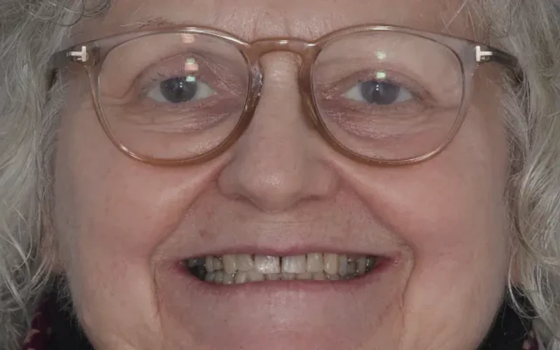 Whitening Before