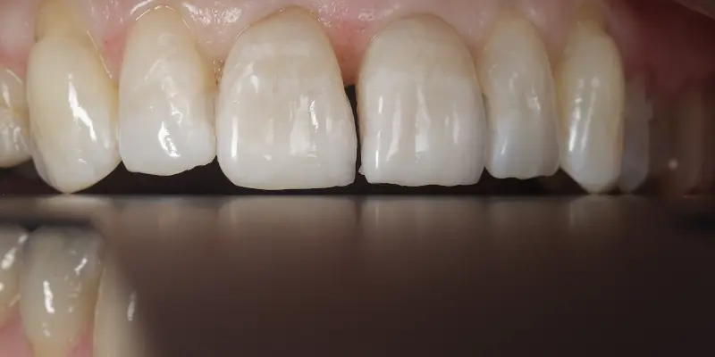 Whitening After