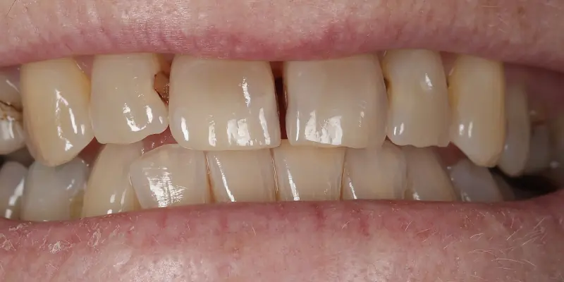 Whitening Before