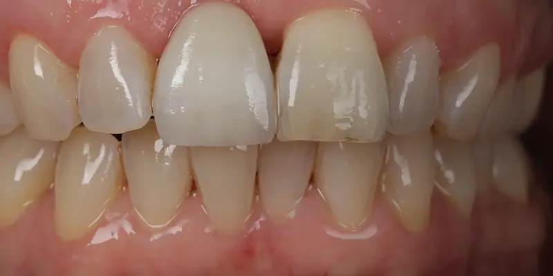 Whitening Before