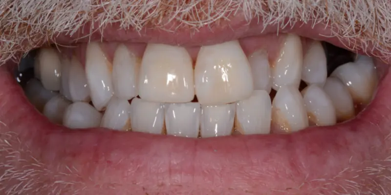 Whitening After