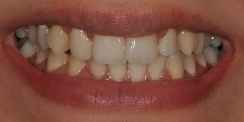 Whitening Before