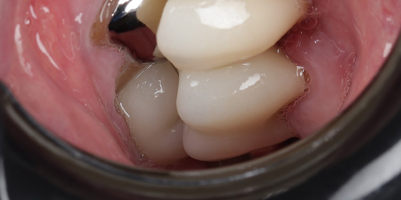 Implant After