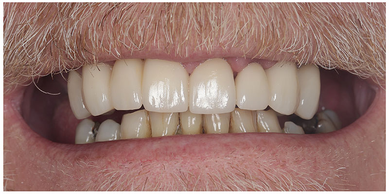Smile Design After