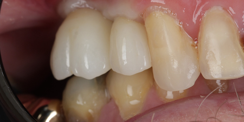 Implant After