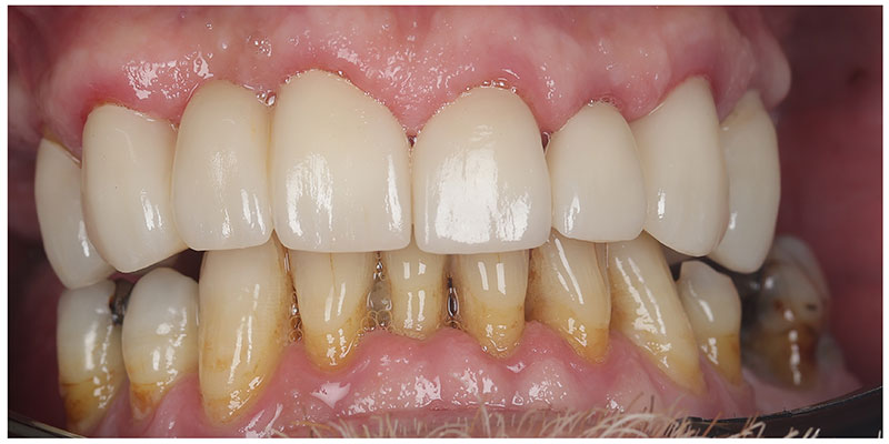 Smile Design After