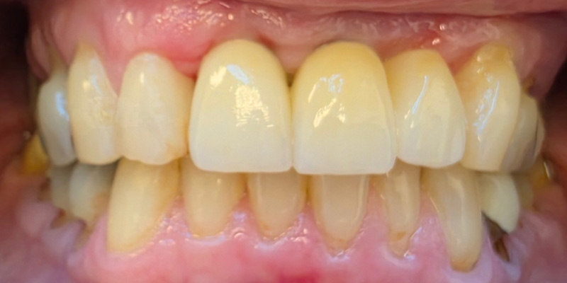 Implant Before