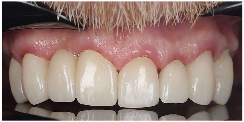 Smile Design After