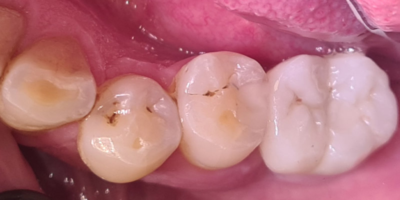 Implant After