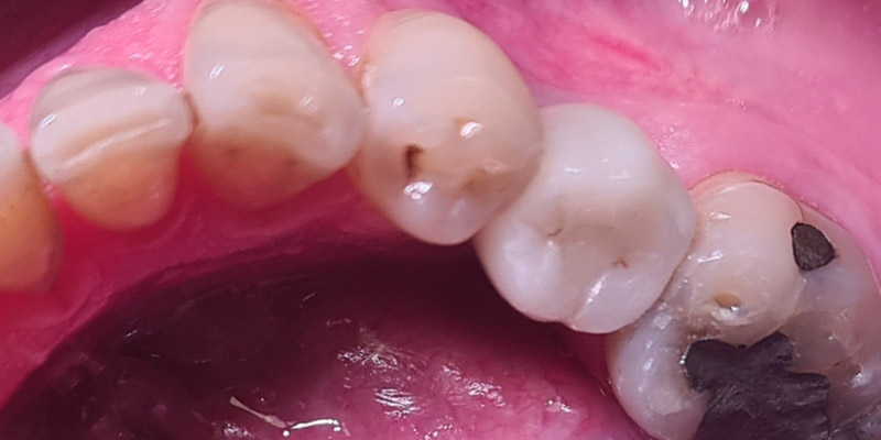 Implant After