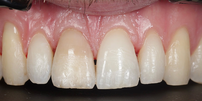 Periodontal After