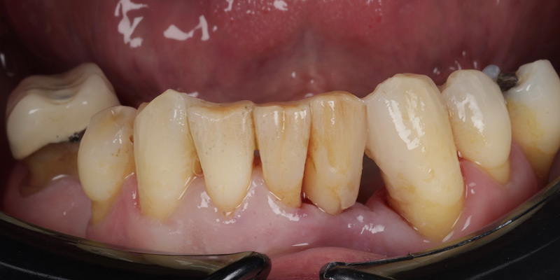 Periodontal After