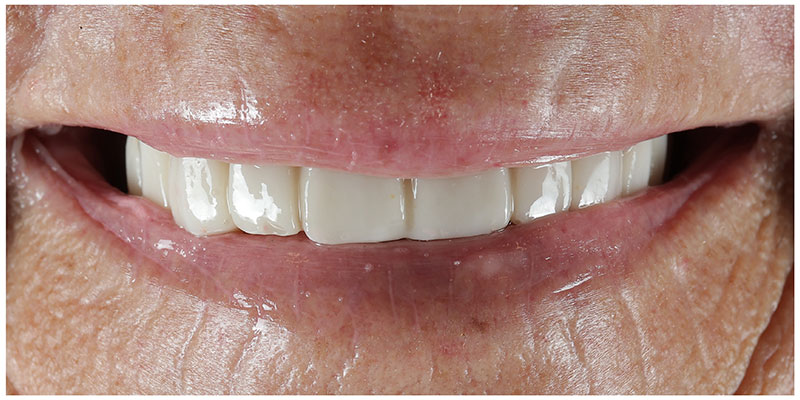 Smile Design After