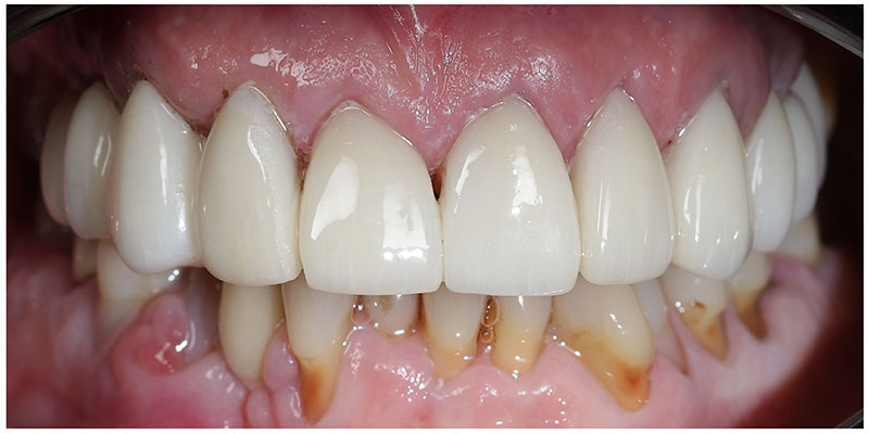 Smile Design After