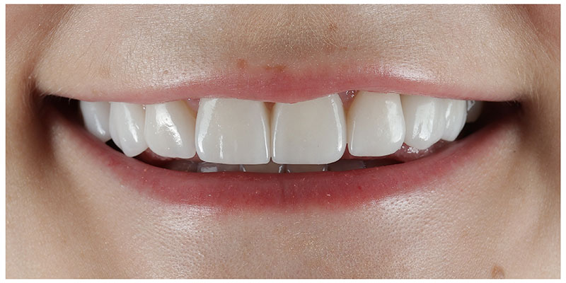 Smile Design After