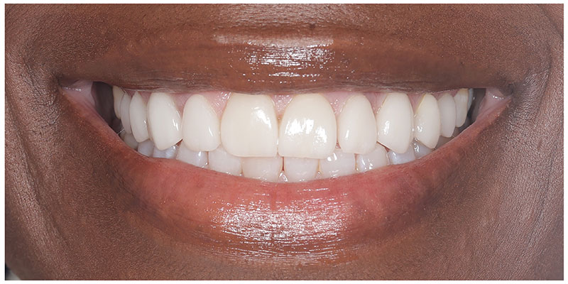 Smile Design After