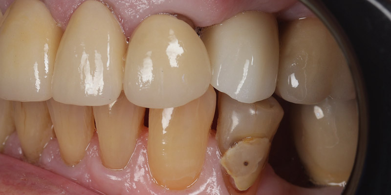 Implant After