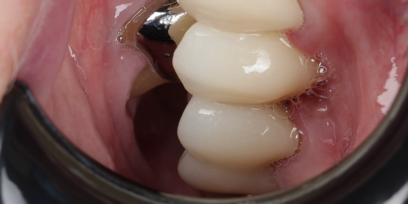 Implant Before