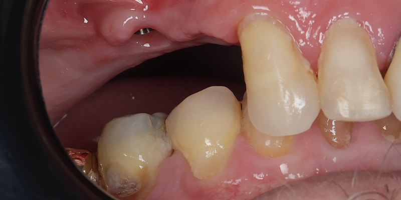 Implant Before