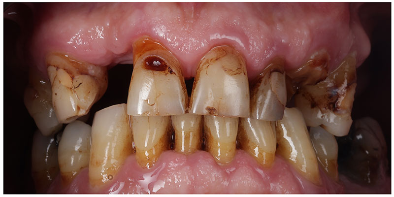 Smile Design Before