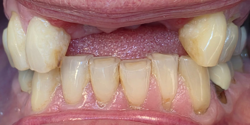 Implant Before