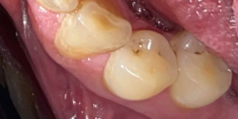 Implant Before