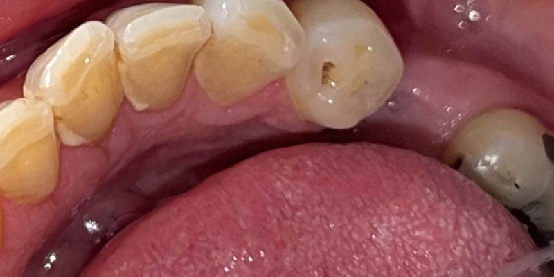 Implant Before