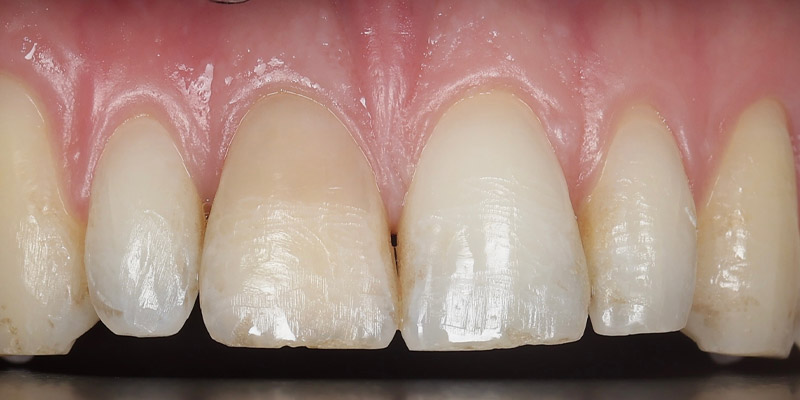 Periodontal Before