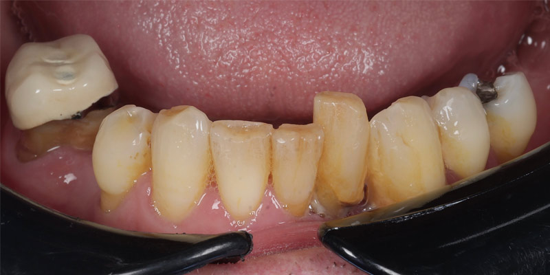 Periodontal Before