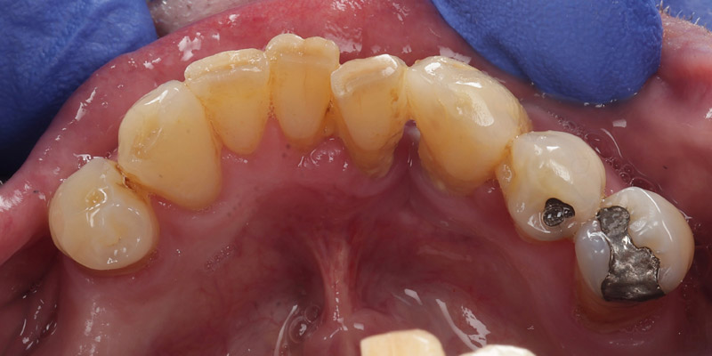 Periodontal Before